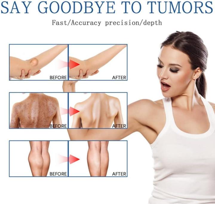Lipoma%20Removal%20Cream%20%7C%20Advanced%20Lipoma%20Treatment%20Cream%20%7C%20Safe%20&%20Gentle%20Use%20-%20Image%203