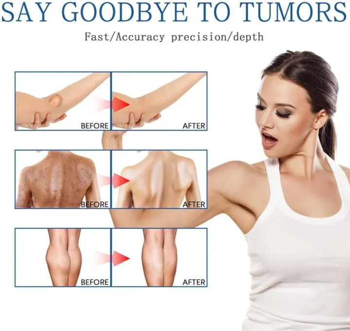 Lipoma%20Removal%20Cream%20%7C%20Non-Surgical%20Lipoma%20Remover%20Cream%20-%20Image%204