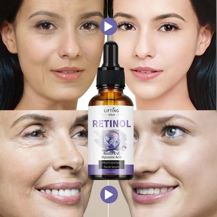 Pack%20Of%202%20Retinol%20Face%20Serum%20%7C%20Anti%20Aging%20Serum%20with%20Hyaluronic%20Acid%20&%20Vitamin%20E%20%7C%20Open%20Pores%20Minimizer%20%7C%20Oil%20Control%20for%20Oily%20Skin%20%7C%20Hydrating%20&%20Moisturizing%20%7C%20Dark%20Spots,%20Acne%20Marks%20&%20Wrinkle%20Repair%20Serum%20-%20Image%202