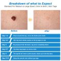 2 In 1 Auto Skin Tag Remover Kit Micro Skin Tag Removal Device Face Care Tools-blue white. 