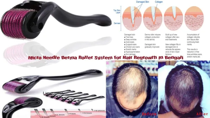 Derma%20Roller%20System%20For%20Hair%20And%20Skin%20(%20540%20Micro%20Needles%20)%20Needle%20Size%201.0mm%20-%20Image%202
