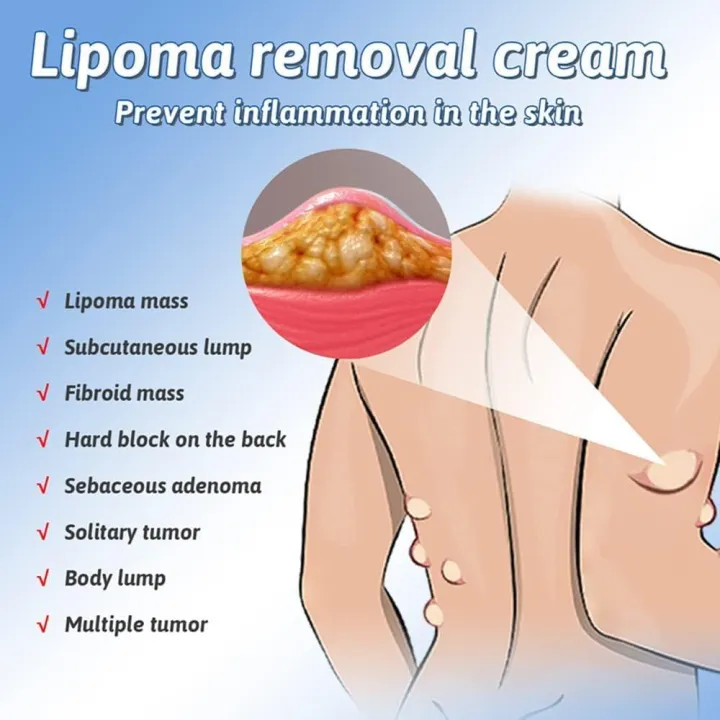 Lipoma%20Removal%20Cream%20South%20Moon%20%7C%20Lipoma%20Removal%20%7C%20Lipoma%20Remover%20-%20Image%205
