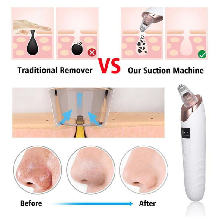 5%20in%201%20Electric%20Blackhead%20Remover%20&%20Whitehead%20Removal%20Machine%20%E2%80%93%20Derma%20Suction%20Blackhead%20Removal%20Machine%20%7C%20Electric%20Blackhead%20Remover%20Machine,%20Blackheads%20Remover,%20Blackheads%20Removal%20Tool,%20Acne%20Oil%20Remover%20Vacuum%20Suction%20Face%20Pore%20Cleaner%20%7C%20Electric%20Facial%20-%20Image%207