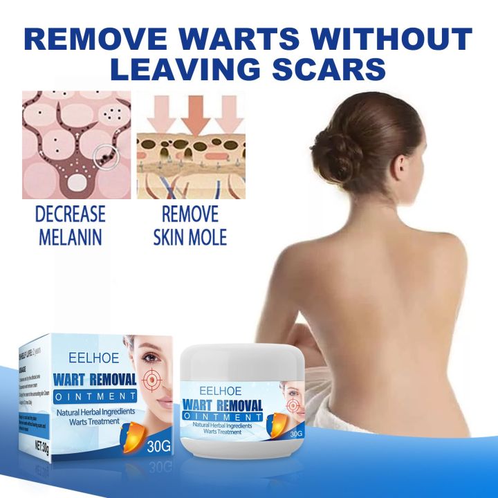 Eelhoe%20Skin%20Tag%20Remover%20Warts%20&%20Mole%20Remover%20Cream%20Remove%20Skin%20Tag%20Wart%20Callus%20Natural%20Ingredients%20Scar-Free%20Wart%20Ointment%2030G%20-%20Image%204