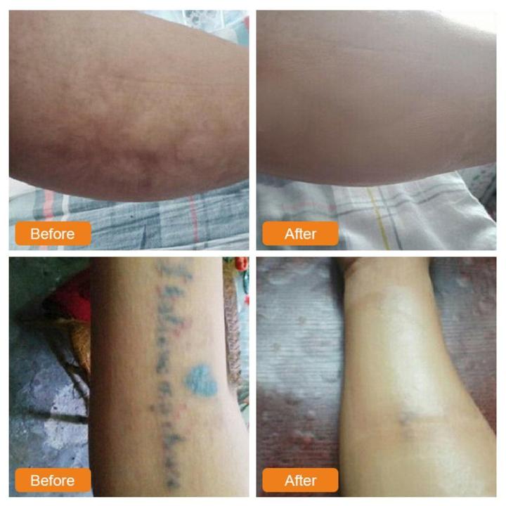 Goglor%20Tattoo%20Scar%20Concealer%20Cover%20Tattoo%20Tape%20Color%20Waterproof%20Seamless%20Removal%20of%20Any%20Spot%20-%20Breathable%20Skin-friendly,%20Fast%20Surface%20Ultra-thin%20Imitation%20Skin%20-%20Image%209