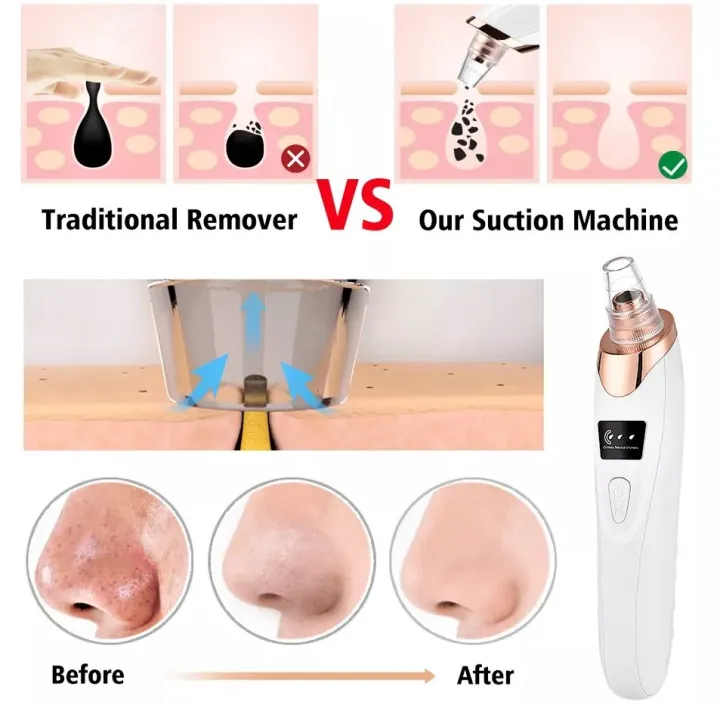 Derma%20Suction%20Blackhead%20Removal%20Machine%204%20in%201%20Black%20Head%20Remover%20Machine%20-%20Acne%20Pore%20Cleaner%20Vacuum%20Sucion%20Tool%20Blackhead%20Removal%20On%20Nose%20Sucing%20Machine%20-%20Image%204