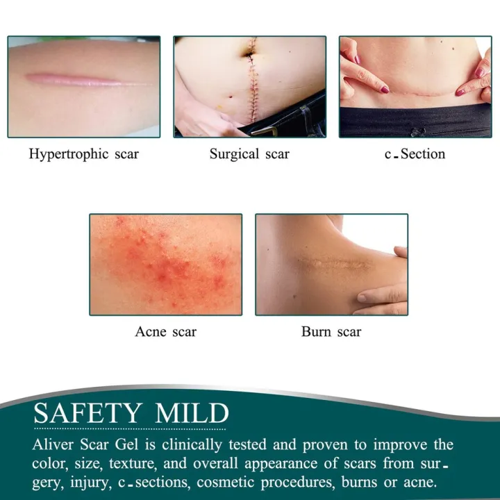 Tape%20Efficient%20Surgery%20Scar%20Removal%20Silicone%20Gel%20Sheet%20Therapy%20Patch%20-%20Image%207