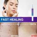 Skin Tag eye Wart Mole Remover Pen Woman Skin Care Removing Against Moles Pimple Patch Remove Black Dot. 