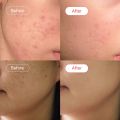 Serum Vitamin C, Niacinamide, Alpha Arbutin (30ml) | AccuFix Cosmetics All in One Face Serum For Pigmentation. 