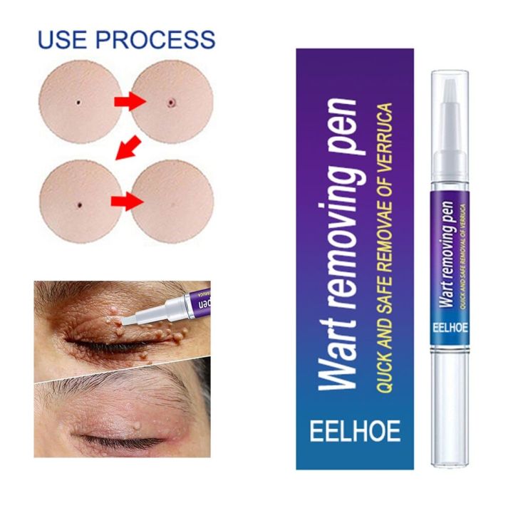 Wart Remover Pen Skin Tag Mole Remover Eliminate Foot Corn Warts