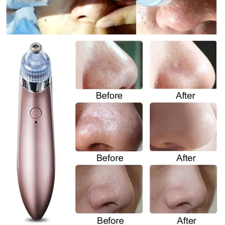 Black%20Head%20Remover%20Machine%20XN%208030%20Rechargeable%20Pore%20Cleaner%20Vacuum%20Negative%20Pressure%20Acne%20Pore%20Cleanser%204%20Changeable%20Head%20-%20Image%202