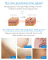 Remove Stretch Marks Cream Anti Wrinkle Maternity Skin Repair Scars Mild 80G. 