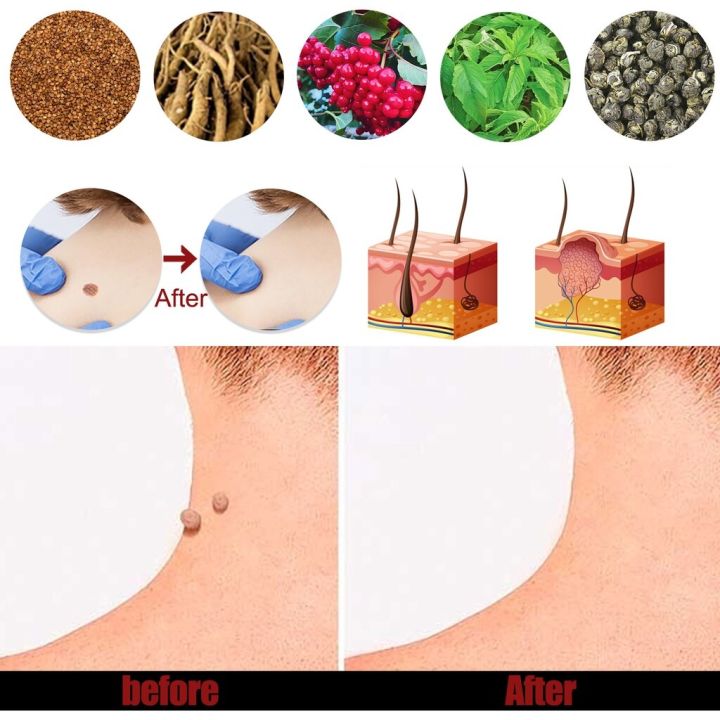 South%20Moon%20Wart%20Removing%20Ointment%20Anti%20Warts%20Ointment%20Hands%20Axillary%20Meat%20Particles%20Neck%20Filamentous%20Smooth%20Wart%20Remover%20Cream%20-%20Image%203