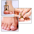 Professional Ingrown Toe Nail Correction Pedicure Toes Treatment Tool for Paronychia, Ingrown Nail Corrector Toenail Foot Nail Care,Eliminate Pain & Remover Orthotic Appliance, Stainless Steel Toes Treatment Manicure Pedicure Tool. 