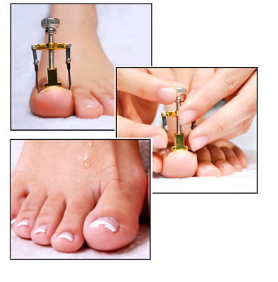 Professional%20Ingrown%20Toe%20Nail%20Correction%20Pedicure%20Toes%20Treatment%20Tool%20for%20Paronychia,%20Ingrown%20Nail%20Corrector%20Toenail%20Foot%20Nail%20Care,Eliminate%20Pain%20&%20Remover%20Orthotic%20Appliance,%20Stainless%20Steel%20Toes%20Treatment%20Manicure%20Pedicure%20Tool%20-%20Image%204