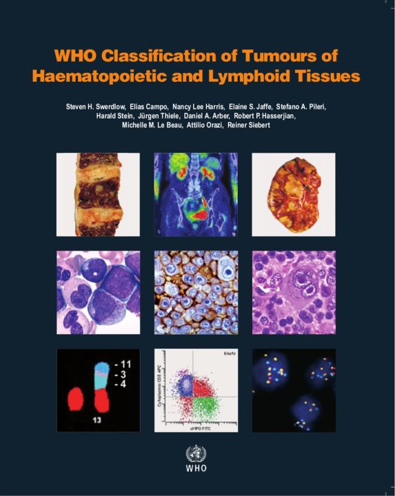 WHO Classification of Tumours of Haematopoietic and Lymphoid Tissues ...