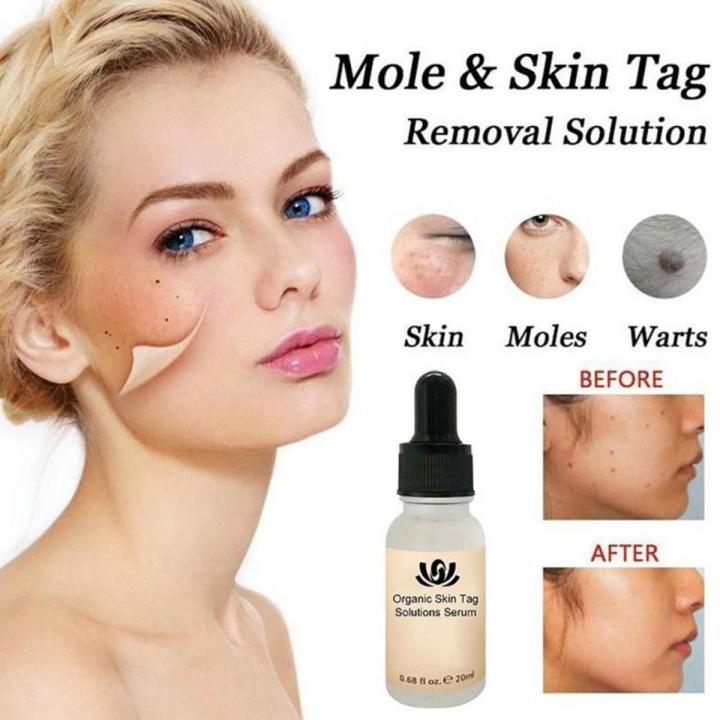20ML Face Mole Skin Serum Removal Solution Painless Mole Skin Dark Spot Removal Face Wart Tag Freckle Removal Cream Oil Plaster