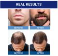 Rogaine 5% Minoxidil Oil 60ml Help Regrow Hair. 