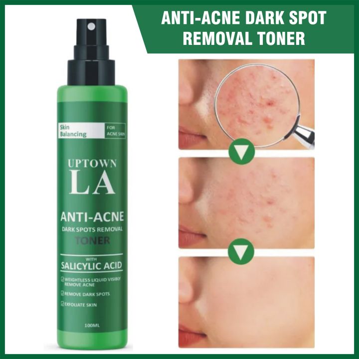 Uptown LA Women's Anti-Acne Face Toner with 2% Salicylic Acid - 100m