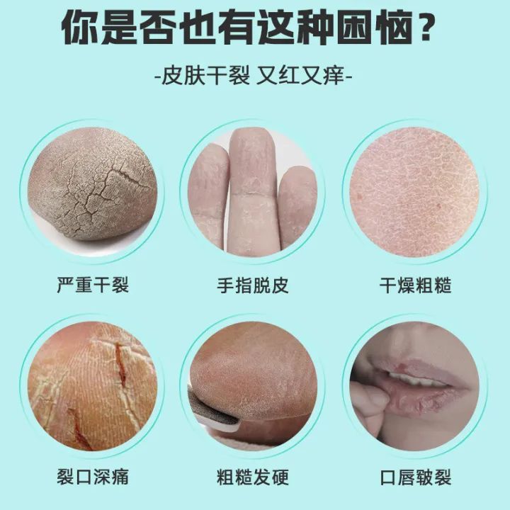 Famous%20German%20medical%20white%20petroleum%20jelly%20large%20jar%20medicinal%20hand%20and%20foot%20cream%20lip%20balm%20lip%20mask%20hand%20mask%20foot%20mask%20dry%20and%20cracked%20skin%20-%20Image%203