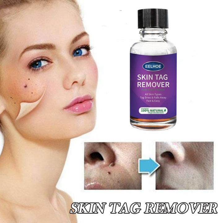 10ml/20ml/30ml/50ml Skin Tag Remover For Common And Plantar Warts Remove