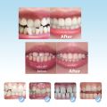 Orthodontic Braces Dental Braces Smile Teeth Alignment Trainer Instanted Silicone Teeth Retainer Guard Braces Tooth Tray for Kid. 