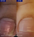 Onychonil Nail Paint | Strengthening & Nourishing Nail Treatment | 20ml. 