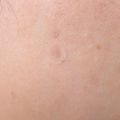 36pcs Acne Removal Pimple Patch Can Absorb Acne Secretions Effectively Invisible Acne Removal Stickers Hydrocolloid Patch. 
