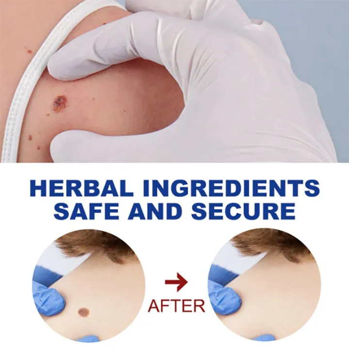 EELHOE%20Skin%20Tag%20Remover%20Eliminate%20Warts%20Remover%20Cream%20Body%20Mole%20Wart%20Remover%20Corn%20Plaster%20Filiform%20Flat%20Warts%205ml%20Free%20Shipping%20-%20Image%207