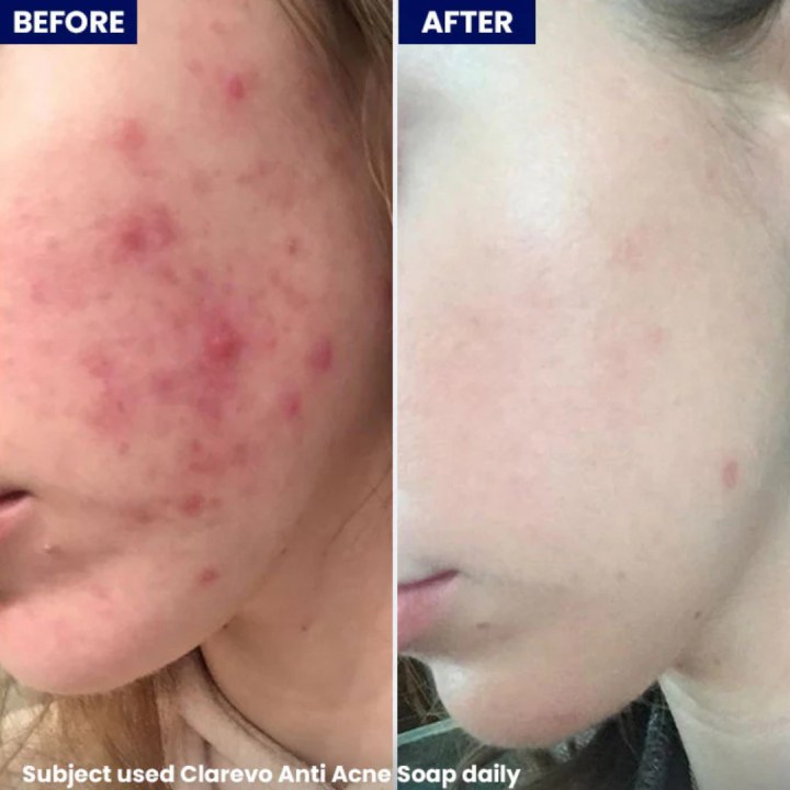 Jenpharm%20-%20Clarevo%20Anti%20Acne%20Soap%20-%20For%20Men%20&%20Women%20%7C%20Cleanse%20Pores%20and%20Controls%20Excess%20Oil%20-%20Reduce%20Breakouts%20-%20For%20Oily,%20Acne-prone%20&%20Combination%20Skin%20-%20Image%206