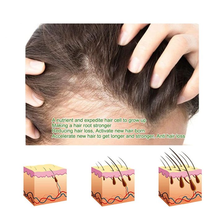 Derma%20Roller%200.5%20Mm%20Hair%20&%20Skin%20System%20-%20High%20quality%20beauty%20dermaroller%20Micro%20pin%20derma%20roller%20540%20needle%20Derma%20Roller%20for%20hair%20regrowth%20facial%20roller%20kit%20-%20Image%205