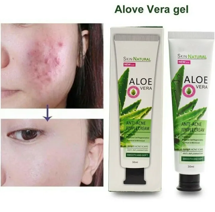 ALOE%20VERA%20ANTI-ACNE%20PIMPLE%20CREAM%2030G%20-%20Image%203
