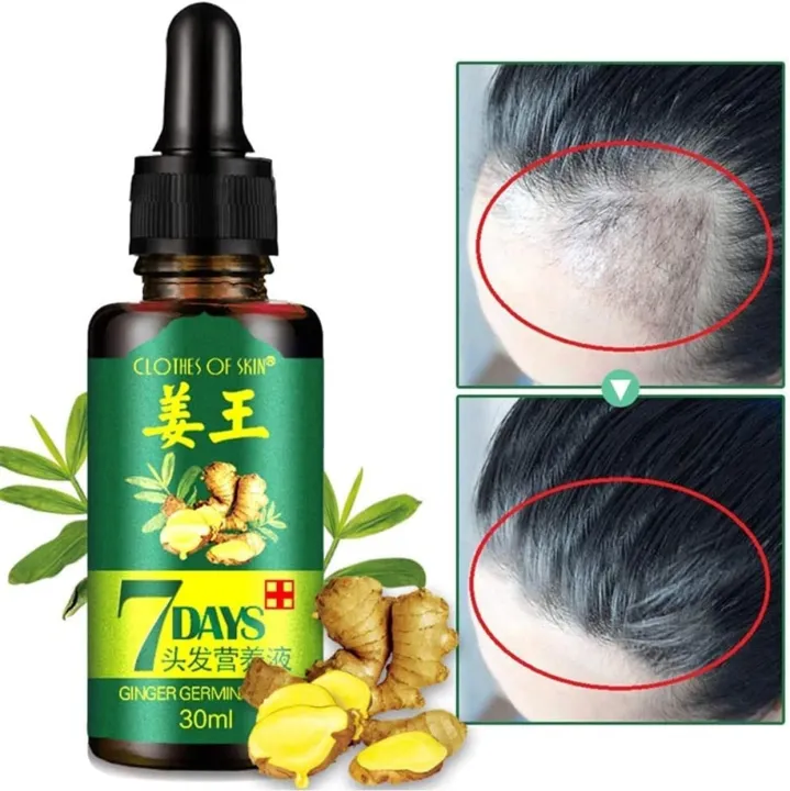 7%20Days%20spray%20Hair%20Growth%20Germinal%20Serum%20Oil%20Natural%20Hair%20Treatment%20Effective%20Fast%20Growth%20Hair%20Care%2030ML%20-%20Image%202
