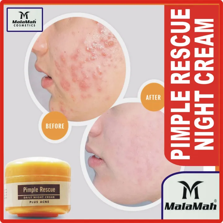 Malamah%20Pimple%20Rescue%20Daily%20Night%20Cream%20AntiAcne%20&%20Anti%20Pimple%20Cream%20(4%20DAYS%20EFFECTIVE)%2056g%20-%20Image%207