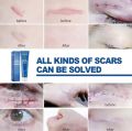 Scar Removal Cream Burn  Scar Treatment. 