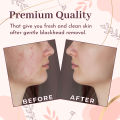 OCBA Blackhead Remover Loop Professional Blackhead & Whitehead Remover Tool for Blemish Comedone Pimple Popper with Double Sided Soft Touch and Anti Slip Design. 