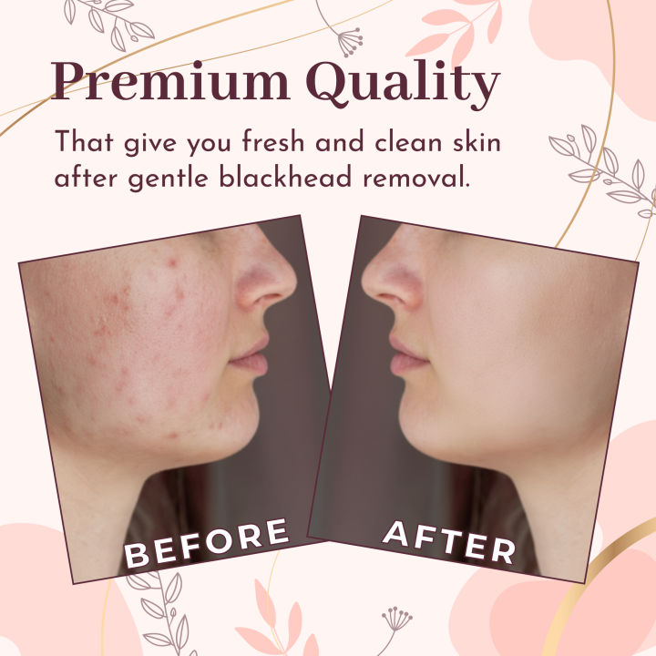 OCBA%20Blackhead%20Remover%20Loop%20Professional%20Blackhead%20&%20Whitehead%20Remover%20Tool%20for%20Blemish%20Comedone%20Pimple%20Popper%20with%20Double%20Sided%20Soft%20Touch%20and%20Anti%20Slip%20Design%20-%20Image%206