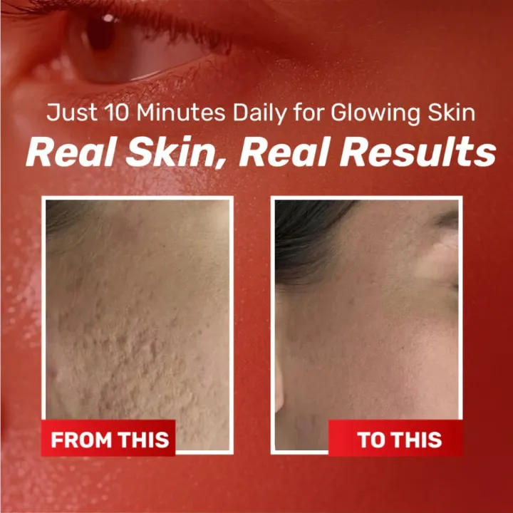 Chalonese%20Brightening%20Cream%2020g%20for%20Acne%20Marks%20&%20Pigmentation%20%7C%20Daily%20Face%20Cream%20for%20Uneven%20Skin%20Tone,%20Dark%20Patches%20&%20Dullness%20%7C%20Gentle%20Formula%20for%20Smooth,%20Clear%20&%20Radiant%20Skin%20-%20Image%205