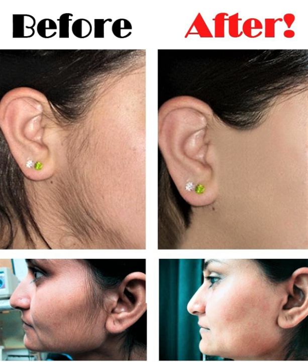 IPL%20laser%20permanent%20hair%20removal%20machine%20with%2010%20Lac%20flashes%20and%20Cooling%20Function_%20Best%20Quality%20Laser%20hair%20removal%20device%20-%20Image%205