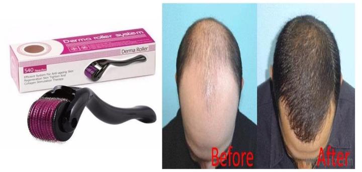 Derma Roller Hair & Skin Rejuvenation System