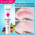 RtopR Scar Removal Cream Acne Scar Treatment Face Face Cream Repair Skin Care Stretch Burn Scar Remover Skin Repair Spots Body Skin Cream 15g. 