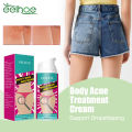 Hip Acne Treatment Cream Butt Inner Thigh Pimples Clearing Remove Dark Spot Prevent Buttock Pores Clogging Body Acne Repair Care. 