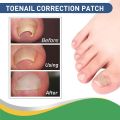 Royal Prestige Ingrown Toenail Pain Reliever Patches (30 Patches) — Fast Relief, Toenail Correction Sticker, Toe Nail Treatment Strips ingrown toenail patches toenail pain reliever toenail correction sticker toe nail treatment foot care patch. 