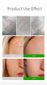 30g Azelaic Acid Gel Gel Acne Cream Removes Acne, Gently Brightens Skin 15% Azelaic Acid Ointment. 