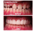 Snap-On Smile Silicone Imitation Braces – Safe & Eco-Friendly Teeth Decoration. 