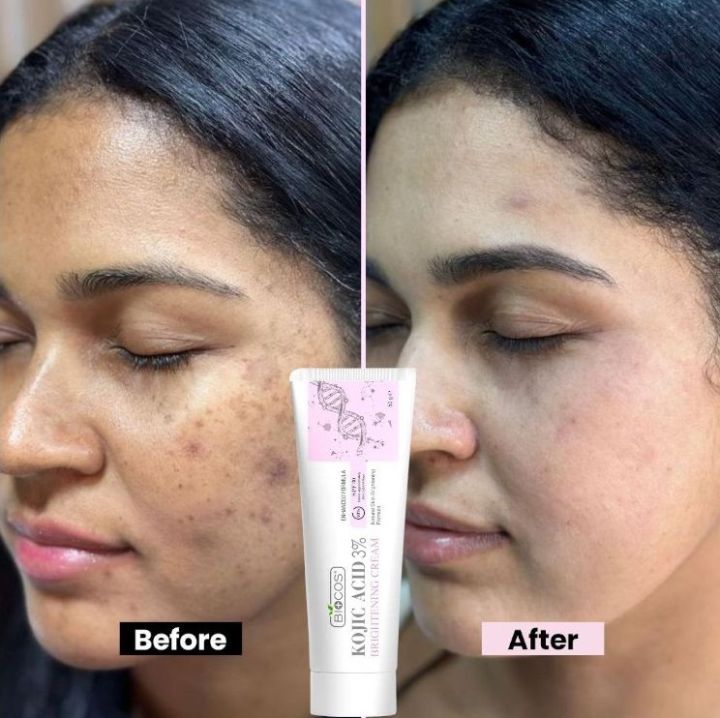 Kojic Acid Cream for Dark Spots & Hyperpigmentation Skin Brightening & Acne Scar Remova Vitamin B5