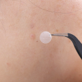 36pcs Acne Removal Pimple Patch Can Absorb Acne Secretions Effectively Invisible Acne Removal Stickers Hydrocolloid Patch. 