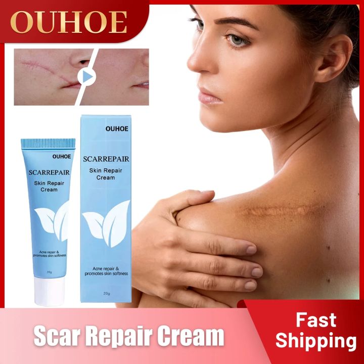 Scar Remover Cream Fade Acne Spots Section Scars Stretch Marks Burn Surgical Treatment Repair Smoothing Whitening Gel Skin Care