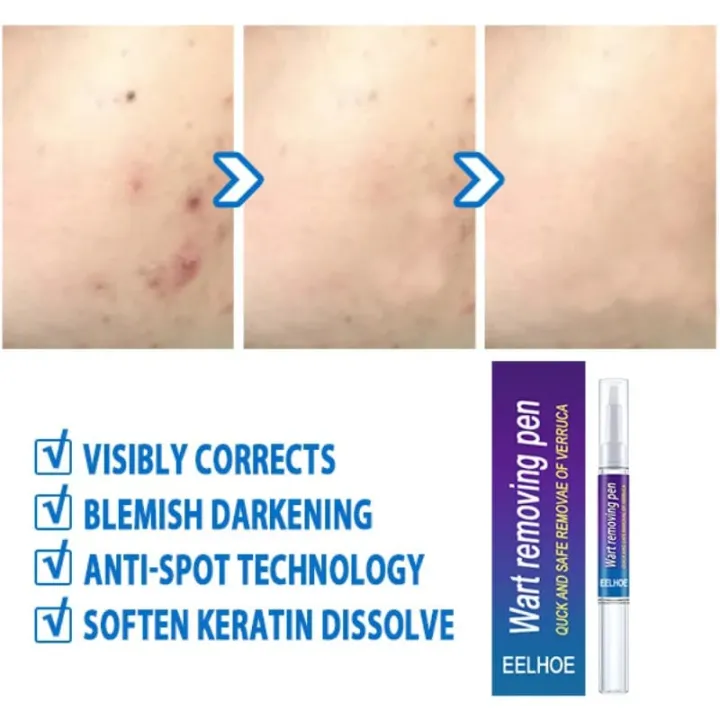 Skin%20Tag%20eye%20Wart%20Mole%20Remover%20Pen%20Woman%20Skin%20Care%20Removing%20Against%20Moles%20Pimple%20Patch%20Remove%20Black%20Dot%20FLAIREX%20-%20Image%205