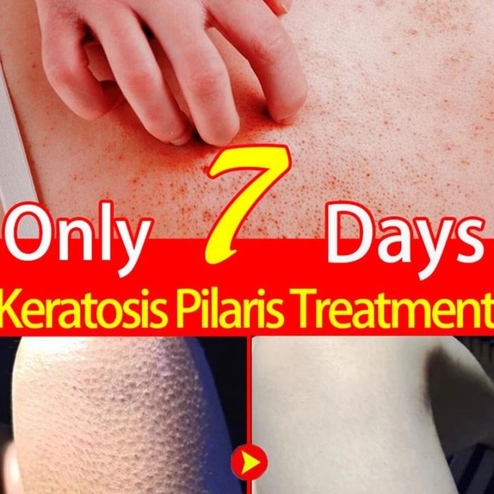 Repair Chicken Skin Cream Keratosis Pilaris Cream For Strawberry Legs Removal Dark Spot Bump Eraser Body Scrub Smooth Lotion
